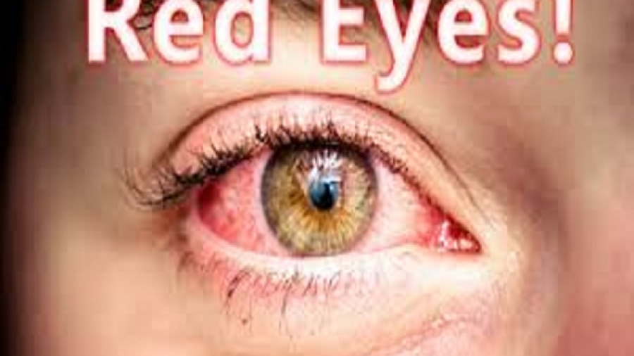 how to get rid of red eyes